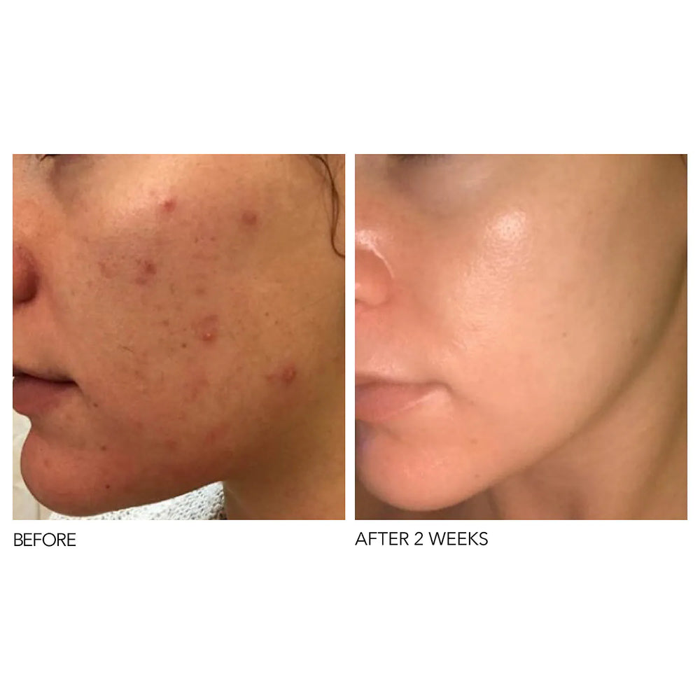 IS Clinical Peel Pad System